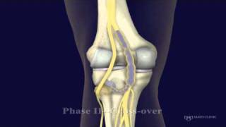 Peroneal and Tibial Intraneural Ganglion Cysts in the Knee Region Video 2 [upl. by Yanal]