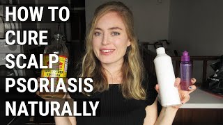 How to Cure Scalp Psoriasis Naturally  5 Years After Shaving My Head [upl. by Ssej]