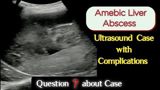 Amebic Liver Abscess  Ultrasound Rare Case showing many Complications [upl. by Odareg]