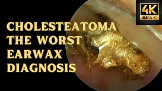 Cholesteatoma  The Worst Earwax Diagnosis [upl. by Peggie]