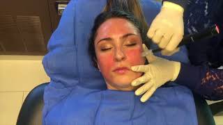 Microneedling with PRP Platelet Rich Plasma quotVampire Facialquot [upl. by Ahserak]