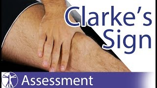 Clarkes Sign  Patellar Grind Test  Patellofemoral Pain  Chondromalacia Patellae [upl. by Kavanaugh]