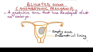 Blighted Ovum Anembryonic pregnancy [upl. by Sairahcaz]