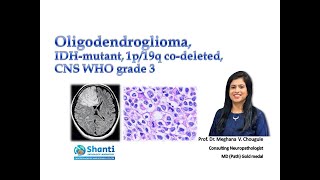 Oligodendroglioma IDH1mutant 1p19q codeleted [upl. by Kciredec121]