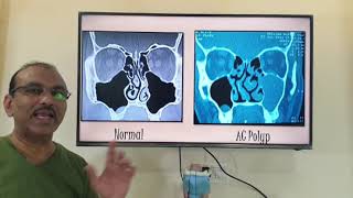 Antrochoanal polyp Hindi Patient teaching programme [upl. by Llahsram]