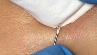 Ingrown Hairs Extraction  16 minutes [upl. by Kaylyn]