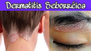 DERMATITIS SEBORRÉICA SÍNTOMAS Y TRATAMIENTO ¡PONLE FIN 😓 [upl. by Garfield81]