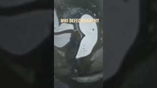 MRI DEFECOGRAPHY  Pelvic Floor [upl. by Bilac]