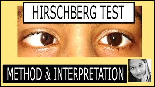 Hirschberg Test Explained Squint simplified for medical students [upl. by Perlie]