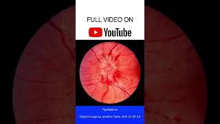 Papilledema Fundoscopy [upl. by Efram]