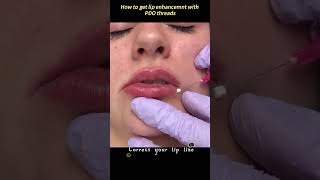 Lip augmentation procedure [upl. by Tcideneb]