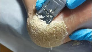 This is for lover of cheese Cracked heel treatment amp Callus removal Dead skin removal Foot care [upl. by Tnelc606]