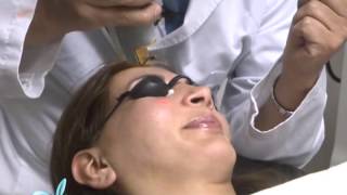 Tratamiento de la Rosacea con Laser DR LUIS EDUARDO MARTINEZ CLINILASER [upl. by Wright28]