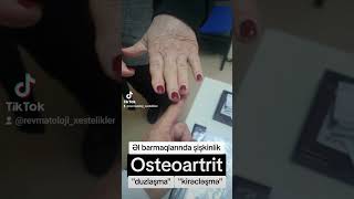 osteoartritis əlbarmaqlarda şişkinlik [upl. by Swart]