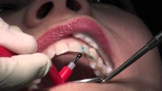 Composite Fillings [upl. by Nowaj]