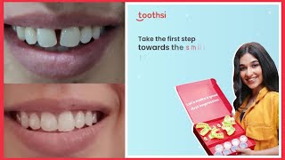 Toothsi Impression kit Recieved for Invisible Aligners [upl. by Diandre]