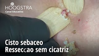 Cisto sebáceo  Ressecção sem cicatriz  23191 [upl. by Nayt]