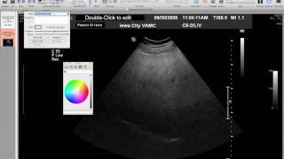 Fixing ID with Osirix [upl. by Einotna778]