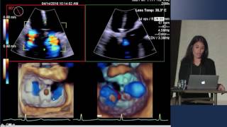 Echo Assessment for MitraClip [upl. by Eed]