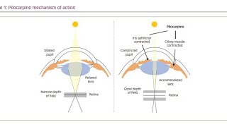 Using Muscarinic Agonist drugs Pilocarpine to treat Glaucoma [upl. by Aridaj676]