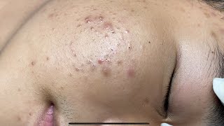 ACNE TREATMENT VU QUYNH MI  Perennial Blackheads On Boy Face 2024FULL [upl. by Middleton]