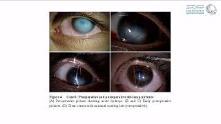 Corneal Hydrops Rethinking Treatment [upl. by Eimmas862]