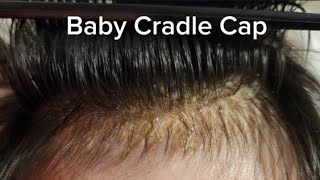 Cradle Cap Removal [upl. by Llenrup637]