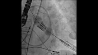 TAVRTranscatheter Aortic Valve Replacement Transapical Deployment [upl. by Lattimer]