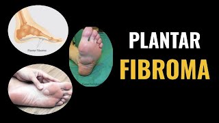 Plantar Fibroma [upl. by Eimmelc937]