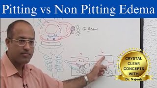 Edema  Pitting vs Non Pitting Edema [upl. by Sacken]