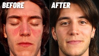 How I Cured My Seborrheic Dermatitis amp Dandruff [upl. by Solracnauj]