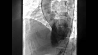 Perimembranous VSD device closure with Symmetrical Perimembranous VSD Occluder PMVSDO [upl. by Riddle]