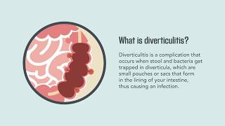 Diverticulitis Signs Symptoms Causes and Treatment  Merck Manual Consumer Version Quick Facts [upl. by Alithea614]