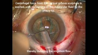 iH during phacoemulsification cataract surgery  ID 124528 [upl. by Drape]