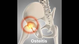 Osteitis inflammation of boneshorts [upl. by Ijok]