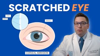 Why Does My Eye Hurt Corneal Abrasions scratched eye [upl. by Cirred]