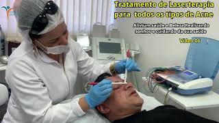 Tratamento de Laserterapia para todos os tipos de Acne [upl. by Descombes]