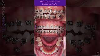 Closing missing tooth space by protracting molars forward with braces and TADs orthodontics [upl. by Lancey]