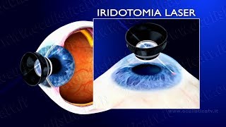 Glaucoma ad angolo chiuso e glaucoma acuto terapia con iridotomia laser wwwoculisticaTVit [upl. by Kohn]