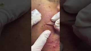 Best Pimple Popping Videos 02 beautiful blackheads sacdepspa [upl. by Annovoj]