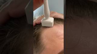 Derma Stamping And Using Minoxidil For Hair Growth [upl. by Mahseh457]