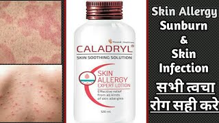 Caladryl Skin Soothing Lotion Review  Skin allergy infection itching amp Sunburn medicine [upl. by Atinhoj]