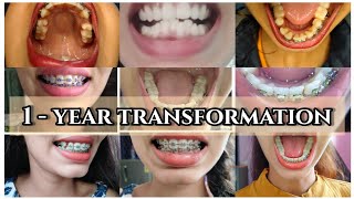 Before and after braces time lapse 1 year braces transformationbraces bracesupdatebracessmile [upl. by Elston186]