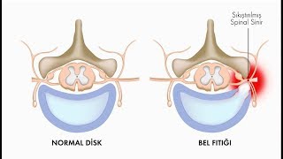 Bel fıtığının belirtileri nelerdir  Prof Dr Onur Yaman Nöroşirürji Uz [upl. by Aicillyhp]