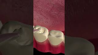 Tooth cavity filling procedure [upl. by Hardie]