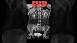 IVP  Intravenous pyelography shorts ivp specialcase radiology radiologyjunction [upl. by Hirsh840]