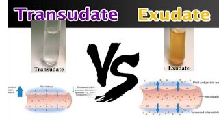 Transudate and Exudate pathology transudate Vs ExudateEasy to understand pathology [upl. by Anayit61]