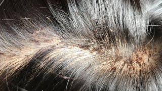 Remove Thousands Of Nits Remove Lice Getting Lice All From Long Hair [upl. by Tadio]