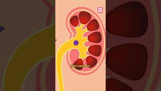 What Causes Kidney Stones  World Kidney Day Special shorts kidneystone worldkidneyday [upl. by Nasah867]