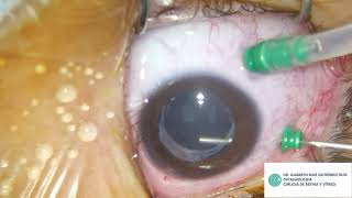 Pars plana capsulotomy and anterior vitrectomyhyaloidotomy [upl. by Samul213]